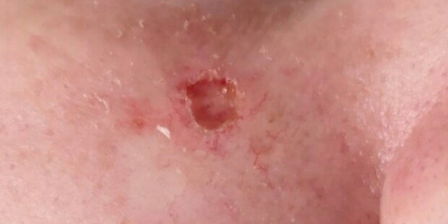 The scar had taken on a different texture than her surrounding skin, and then she accidentally scratched it, which set off a series of infections.