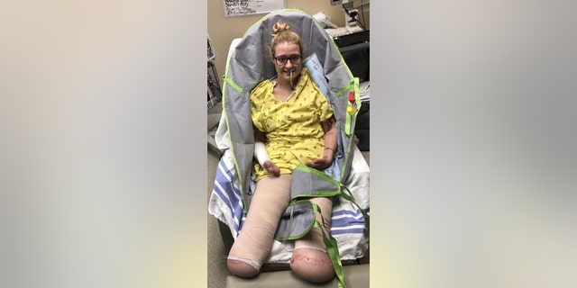 She underwent a total of 25 surgeries including multiple amputations and operations to cut away dead tissue.