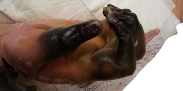 When she woke from a coma, she discovered her fingers and lower legs had turned black.