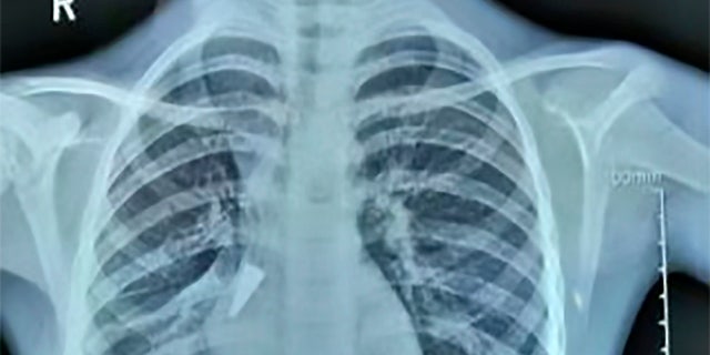 A scan showing the metal pen cap in the girl's lung.