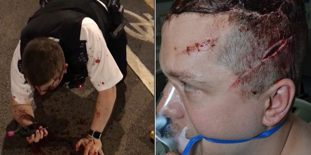 Outten is pictured left after discharging his Taser and stopping Rodwan's assault. He is pictured right following surgery for his multiple injuries.