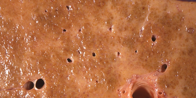 This 1971 photo made available by the Centers for Disease Control and Prevention shows an alcoholic cirrhosis liver specimen from an autopsy showing a dense network of scar tissue in response to chronic injury from alcohol abuse. (Dr. Edwin P. Ewing, Jr./CDC via AP)