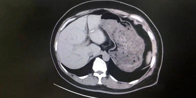 Westlake Legal Group SwimmingBone Fish bone removed from woman's liver after she swallowed it 8 years ago, report says fox-news/world/world-regions/china fox-news/health/wellness fox-news/health/medical-research/surgery fox-news/health/digestive-health fox news fnc/health fnc article Alexandria Hein 095646c0-a466-5704-9c8d-90b8f659e70c