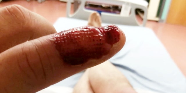 Steven MacDonald, 48, was rushed to hospital just days after noticing his left index finger had become infected.
