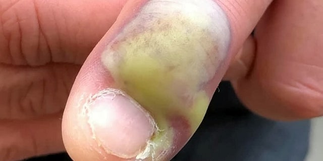 The man's infected nail.
