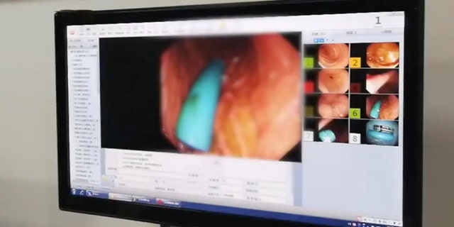 Doctors removed the leaking battery from the woman's stomach 14 days after she swallowed it.