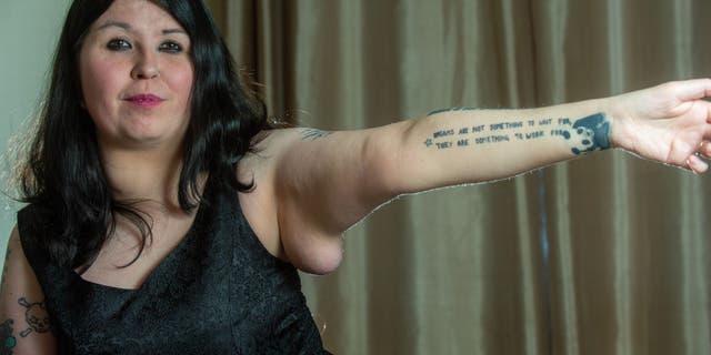 Nikita Berryman from Frome wants her lipoma removed before her wedding.