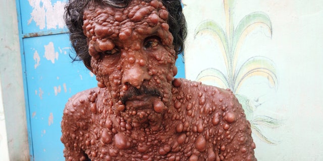 Diwaker Bisoye said he is treated worse than "a dirty stray animal" by people who don't understand his condition.