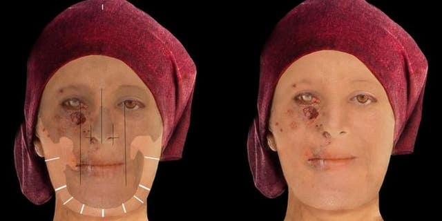 Leprosy mutilated the face of this high-status woman, who lived from the mid-15th to the 16th century in Scotland. (The City of Edinburgh Council)