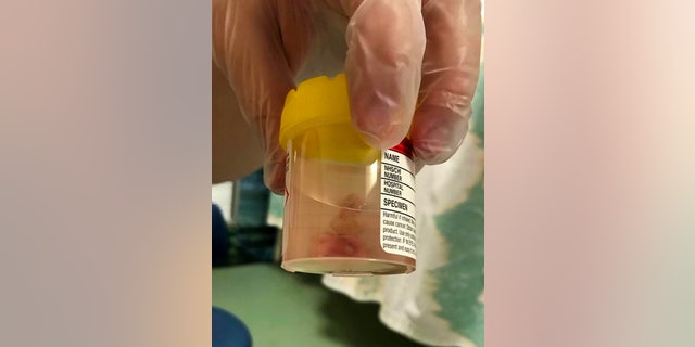 The abnormal cells taken from her cervix.