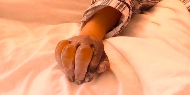 The 13-year-old's condition has reportedly improved but continues to be monitored by a burn specialist.