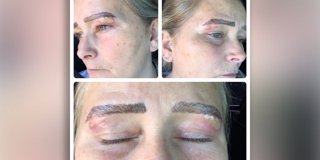Shannon Bozell?claims she went back to a salon where she had a microblading procedure to have her eyebrows reshaped, but left with blisters and scarring.