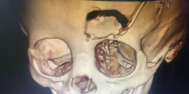 A scan showing a bone flap created to retrieve the skull fragment in the boy's head