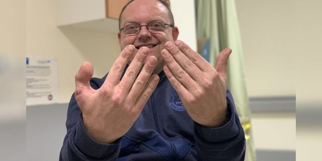 “I shouted for someone to ring an ambulance but I couldn’t see how bad it was. I saw my thumb drop on the floor,” David Lee told SWNS.