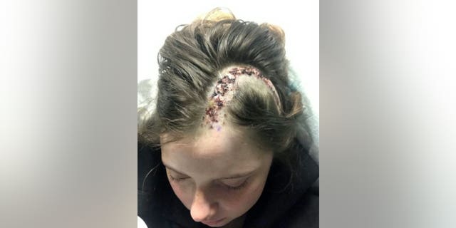 Laura Skerritt's post-operation scar. (SWNS)