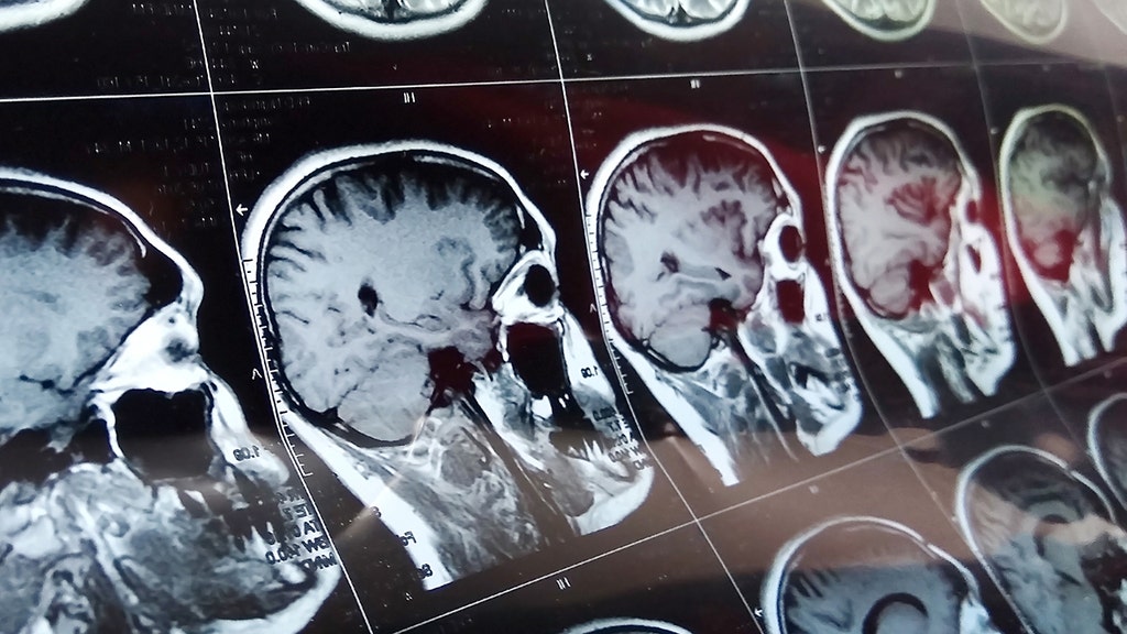 Bizarre brain disease 'cluster' prompts race to find potential cause in Canada