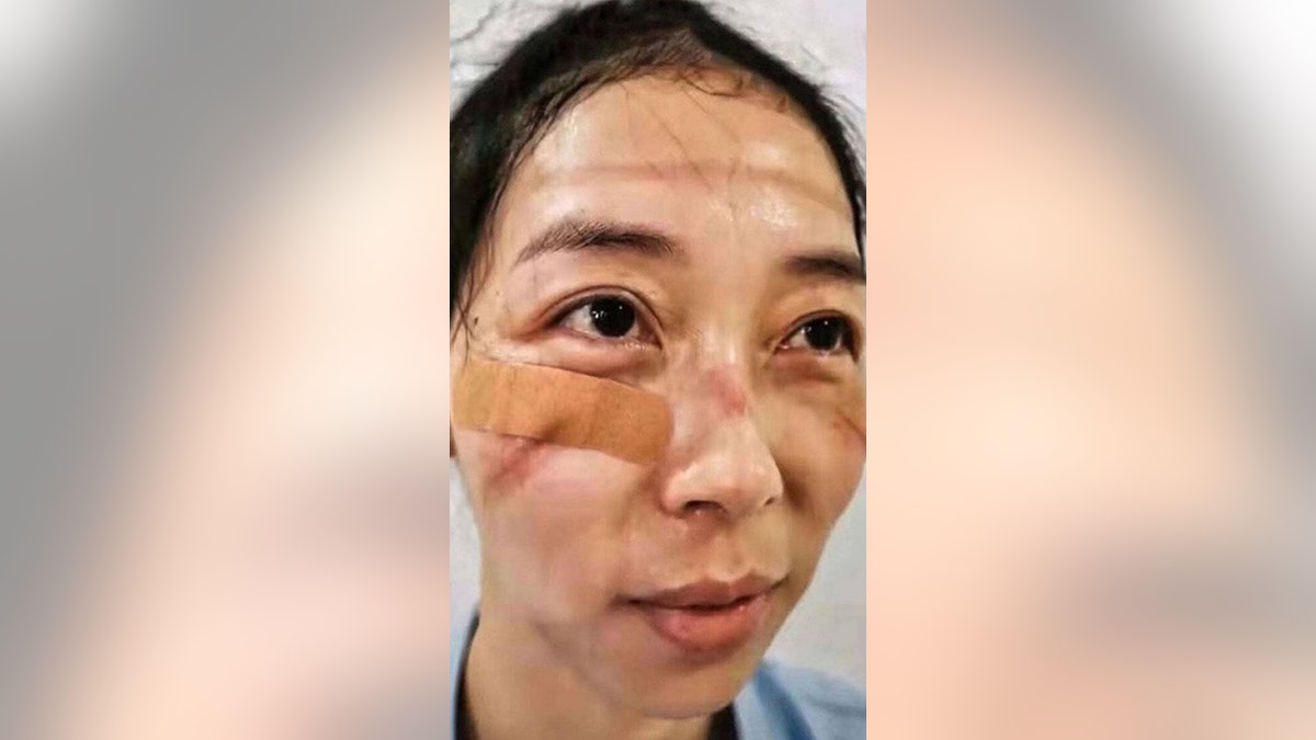 A nurse shared a photo of the marks left on her face by safety goggles after working long hours to treat coronavirus patients.