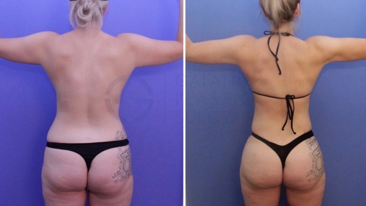 What Makes the Brazilian Butt Lift So Popular? - Bose Plastic Surgery