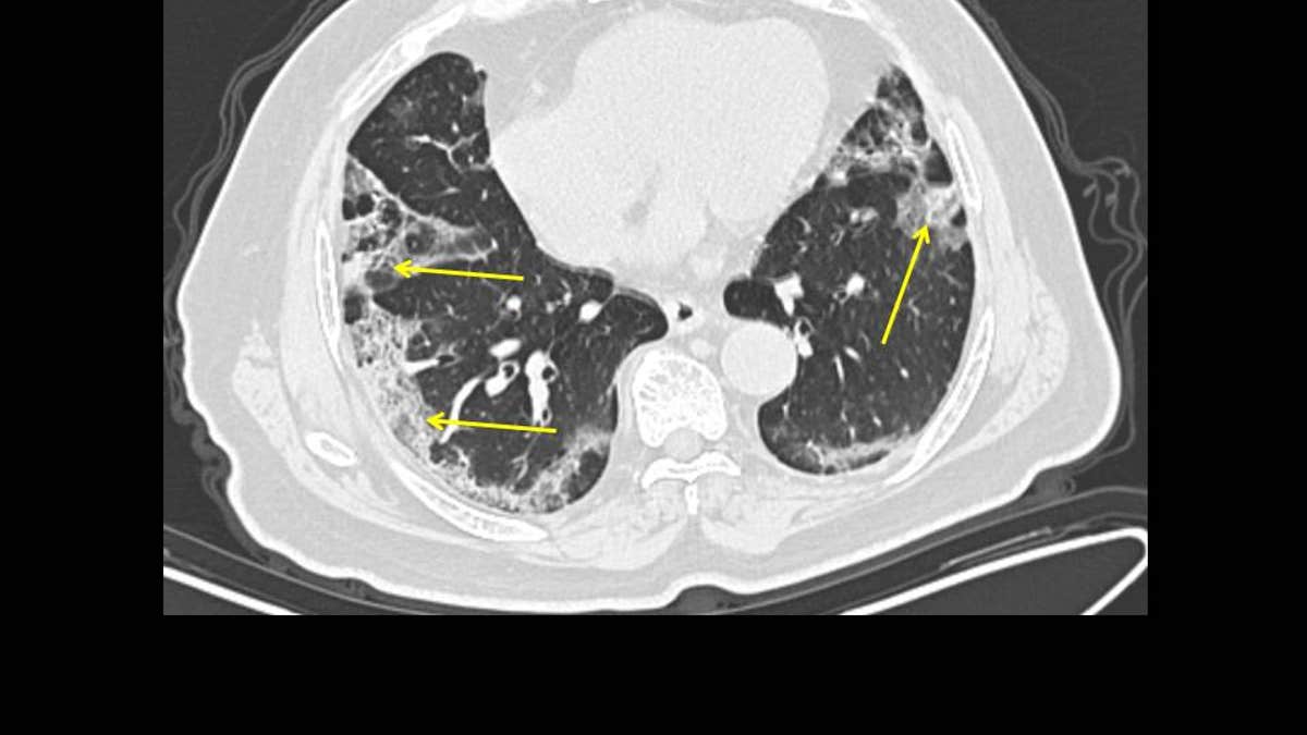 A 65-year-old male with a history of travel to Wuhan, presenting with fever and cough. CT scan obtained 11 days from onset of symptoms (late group) shows moderate lung disease with peripheral ground glass opacities in the lungs (arrows).