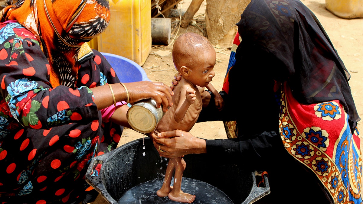 In this Aug. 25, 2018 file photo, a severely malnourished infant is bathed in a bucket in Aslam, Hajjah, Yemen. (AP Photo/Hammadi Issa, File)