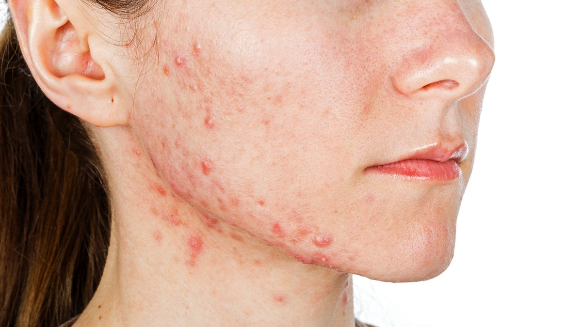 Teens and adults alike can be affected by acne.