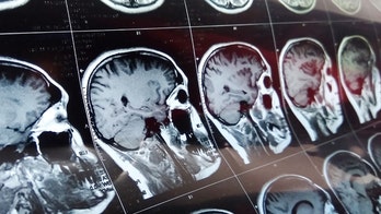 Mysterious brain disease 'cluster' under investigation in Canada