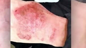 Coronavirus doctor's hands left bloodied after working round-the-clock