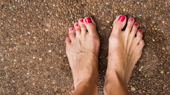 What causes a bunion and do you need surgery to fix it?