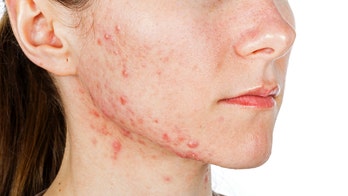 What is acne? What to know about the skin condition that affects more than just teens