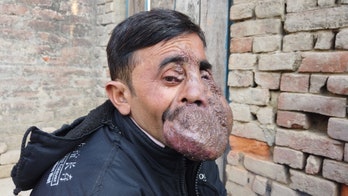 Indian man born with massive facial tumor says he's nearly ‘exhausted my savings’ in search for cure
