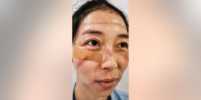 A nurse shared a photo of the marks left on her face by safety goggles after working long hours to treat coronavirus patients.
