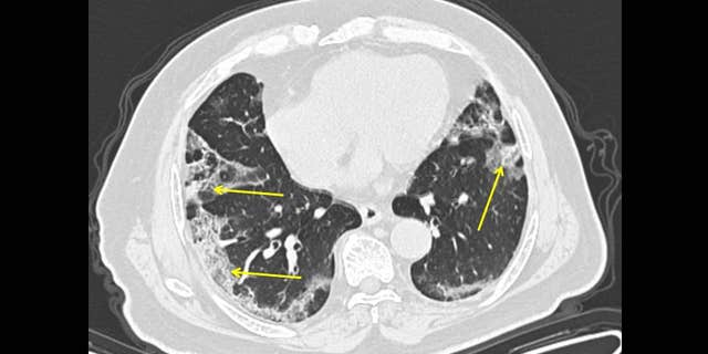 First US docs to analyze coronavirus patients’ lungs say insight could lead to quicker diagnosis 2 A 65-year-old male with a history of travel to Wuhan, presenting with fever and cough. CT scan obtained 11 days from onset of symptoms (late group) shows moderate lung disease with peripheral ground glass opacities in the lungs (arrows).