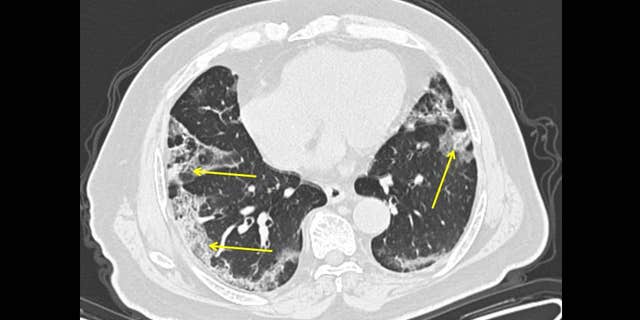 A 65-year-old male with a history of travel to Wuhan, presenting with fever and cough. CT scan obtained 11 days from onset of symptoms (late group) shows moderate lung disease with peripheral ground glass opacities in the lungs (arrows).