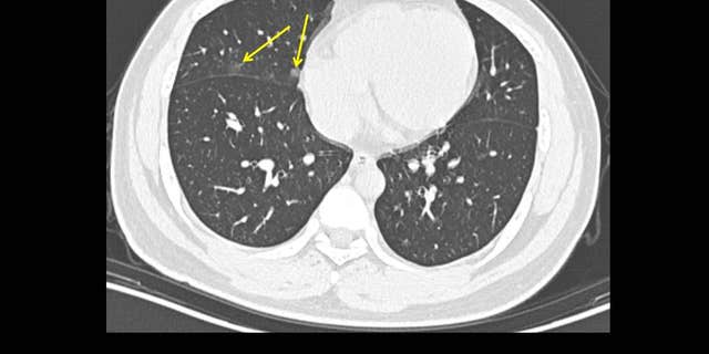 A 19-year-old male with history of travel to Wuhan presenting with fevers. CT scan obtained just 1 day after symptom onset shows minimal lung disease, with very small amounts of ground glass in the right lung (arrows).