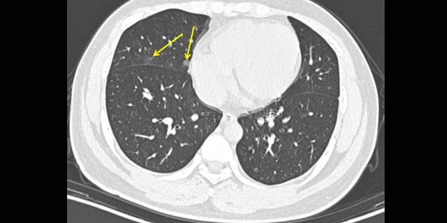 A 19-year-old male with history of travel to Wuhan presenting with fevers. CT scan obtained just 1 day after symptom onset shows minimal lung disease, with very small amounts of ground glass in the right lung (arrows).