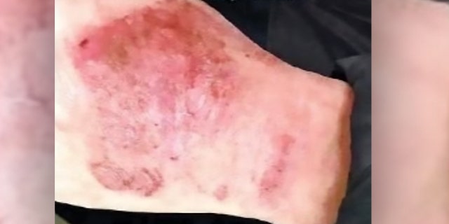 Le Dr Chen Jun a déclaré que ses mains avaient été irritées et crues par de longues heures passées dans des gants de protection.