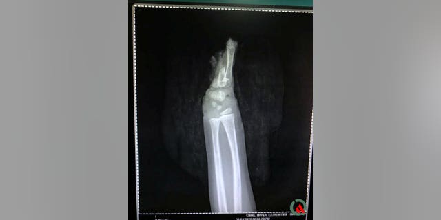 X-ray of Shaurya Undre's arm with his missing hand.