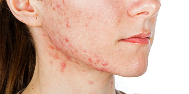 Teens and adults alike can be affected by acne.
