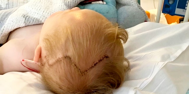 Ronnie Jebbitt was born with craniosynostosis.