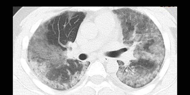 A 29-year-old male with unknown exposure history, presenting with fever and cough, ultimately requiring intensive care unit admission. The CT scan image shows diffuse bilateral confluent and patchy ground-glass and consolidative pulmonary opacities, with a striking peripheral distribution in the right lower lobe.
