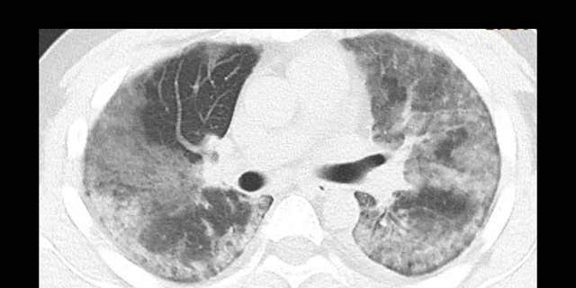 A 29-year-old male with unknown exposure history, presenting with fever and cough, ultimately requiring intensive care unit admission. The CT scan image shows diffuse bilateral confluent and patchy ground-glass and consolidative pulmonary opacities, with a striking peripheral distribution in the right lower lobe.