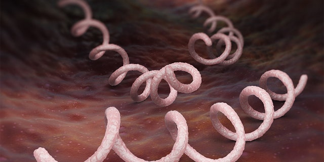 Syphilis is a sexually transmitted infection caused by the spirochete bacterium