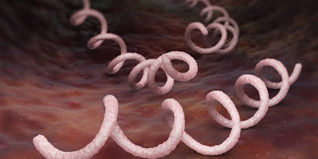 Syphilis is a sexually transmitted infection caused by the spirochete bacterium