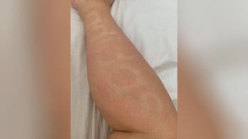 Woman accidentally tans company logo onto her leg during coronavirus lockdown