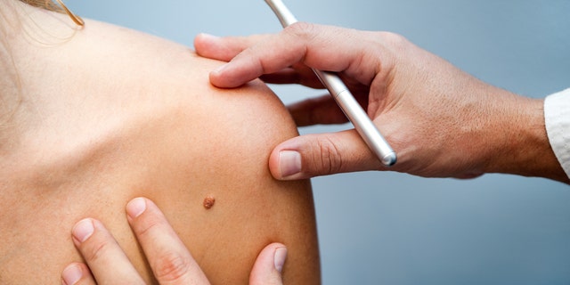 It's always best to consult a dermatologist if you have a skin tag or mole you would like removed.