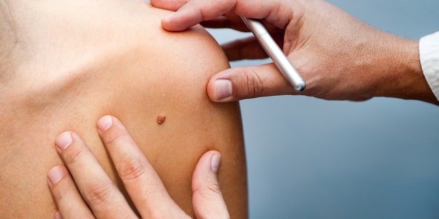 It's always best to consult a dermatologist if you have a skin tag or mole you would like removed.