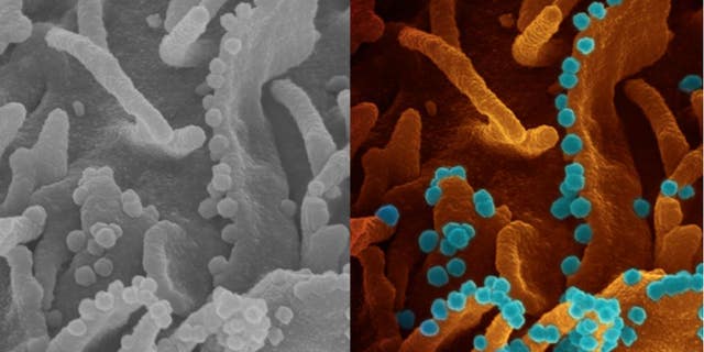 positive news SARS-CoV-2, the novel coronavirus, is seen above.