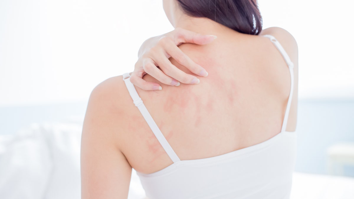 Numerous reports of skin rashes in patients with COVID-19 are cropping up around the world. (iStock)