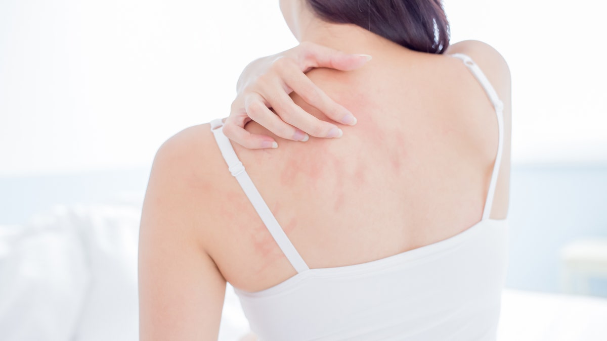 Numerous reports of skin rashes in patients with COVID-19 are cropping up around the world. (iStock)