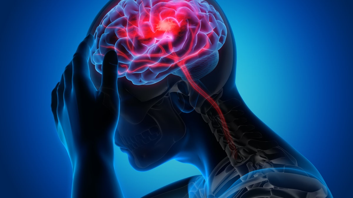 Medical illustration of a brain with stroke symptoms